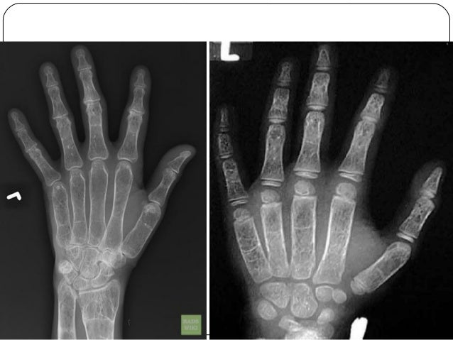 Radiology of Thalassemia